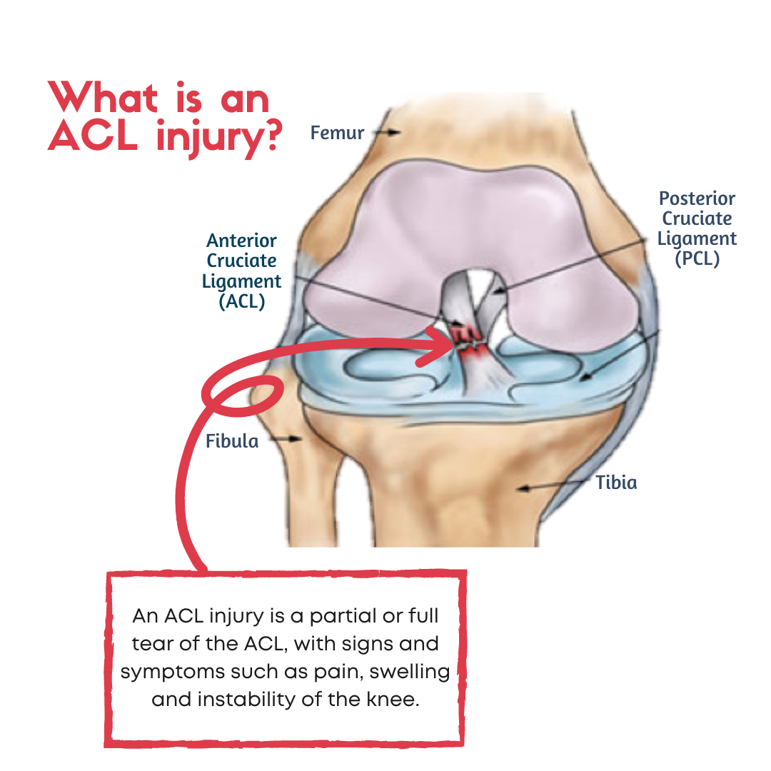 1 ACL Injury Recap.png